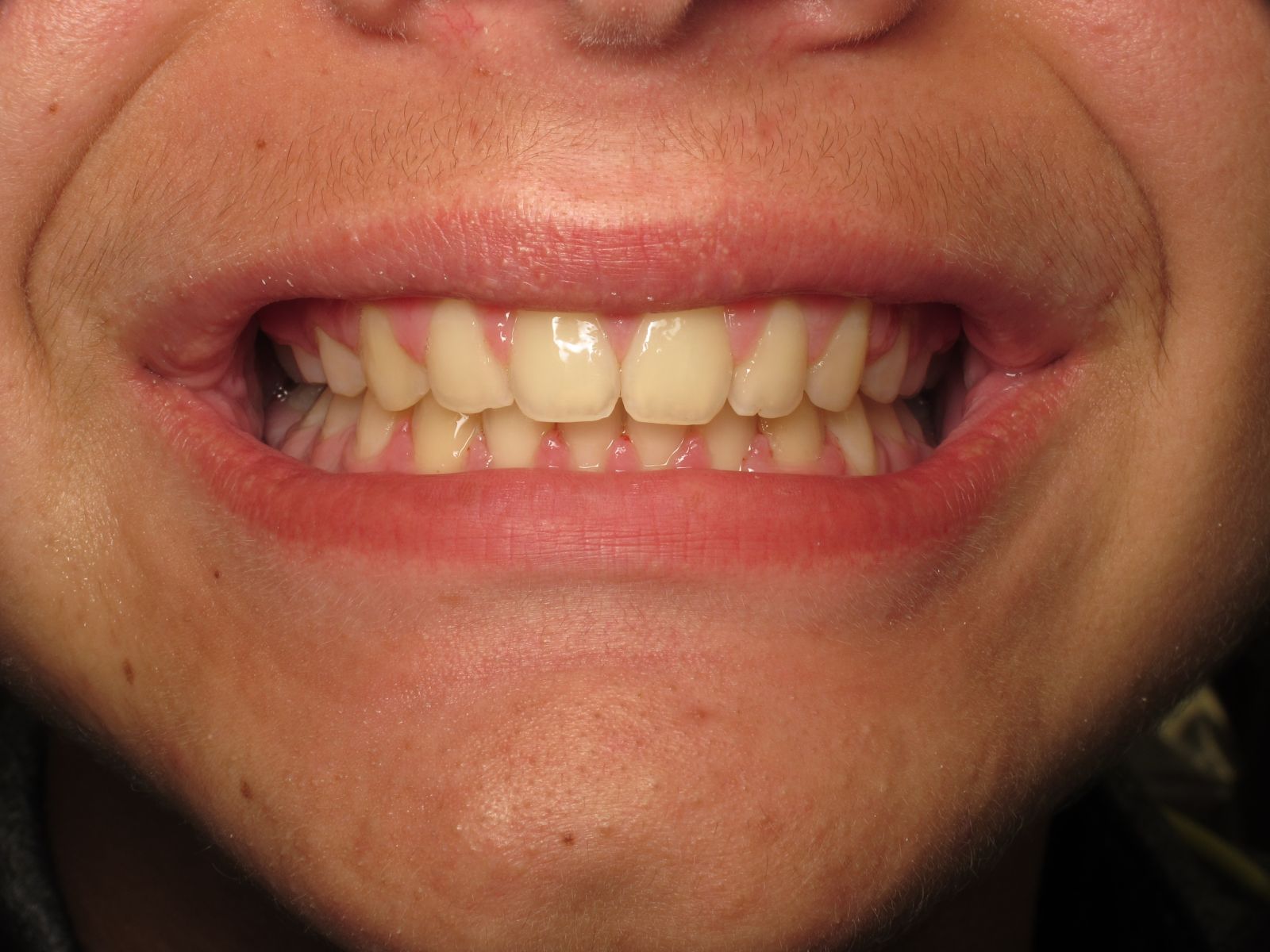 Before & After Harrisonville, MO Custom Dental of Harrisonville